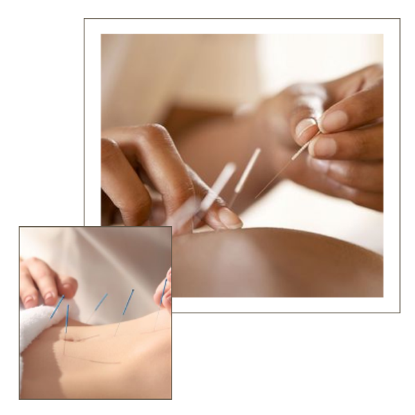 ACUPUNCTURE