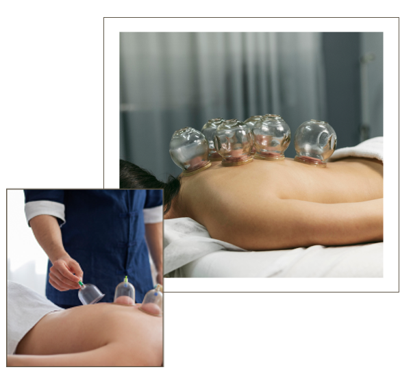 CUPPING