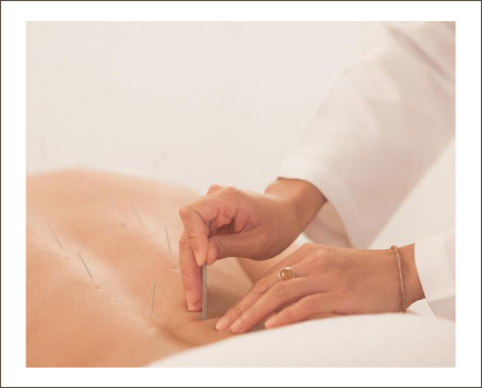 ACUPUNCTURE